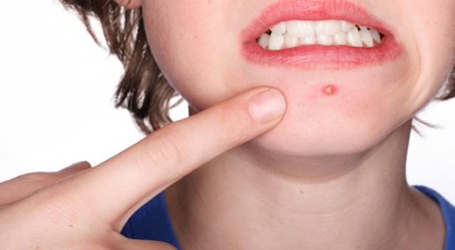 sivilce neden çıkar